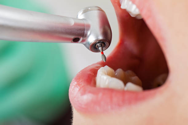 Best Urgent Care for Lost Fillings or Crowns in Wesleyville, PA